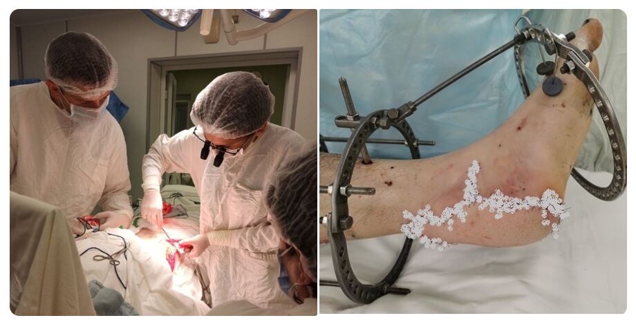 Левую ногу затянуло в ленточную пилу»: ярославские врачи провели уникальную операцию
